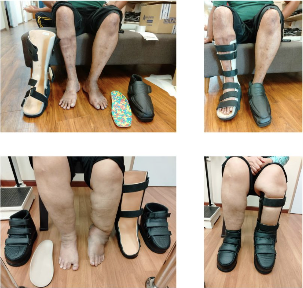 Custom made ankle/foot orthosis